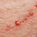 why do cat scratches sting